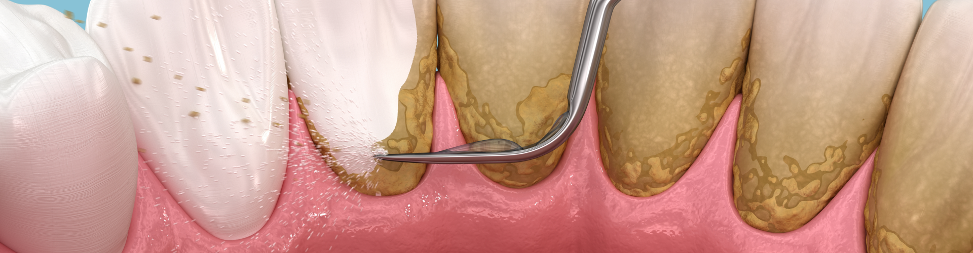 dental scraper removing buildup from back of teeth